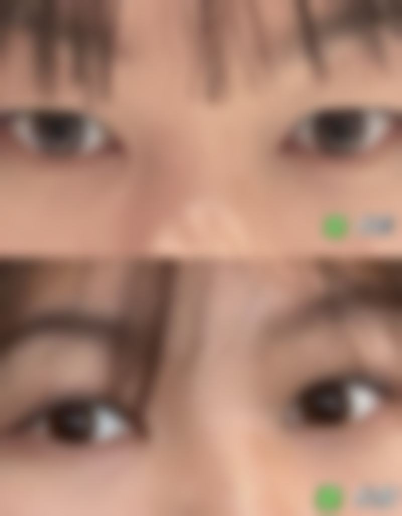 生姜敷眼袋靠谱吗？了解眼袋成因与改善方案，正规医院助你科学护眼 