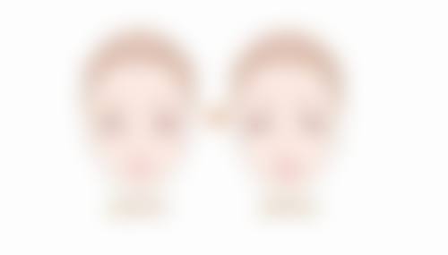 隆鼻后鼻头红点不消怎么办?选择正规机构有保护