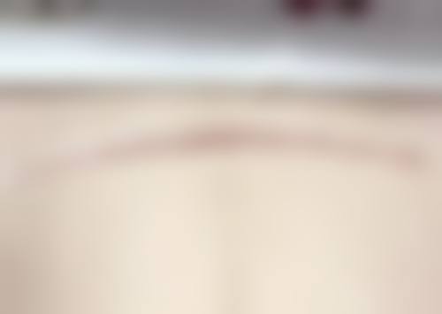 潘姝增生性瘢痕的防治水平怎么样可靠吗？