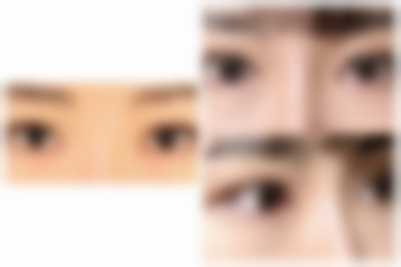 隆鼻后鼻头红点不消怎么办?选择合适方案解决问题