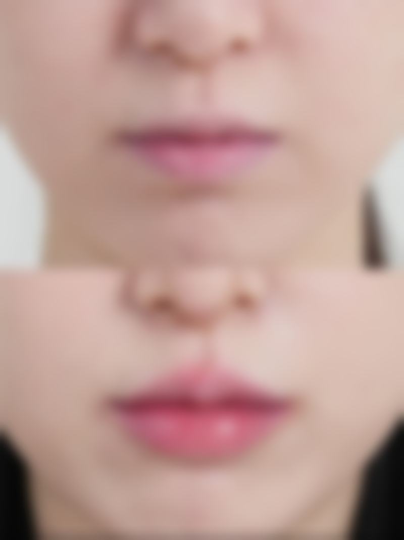 假体隆胸后多久能安心触摸？初步稳定期的触摸尝试