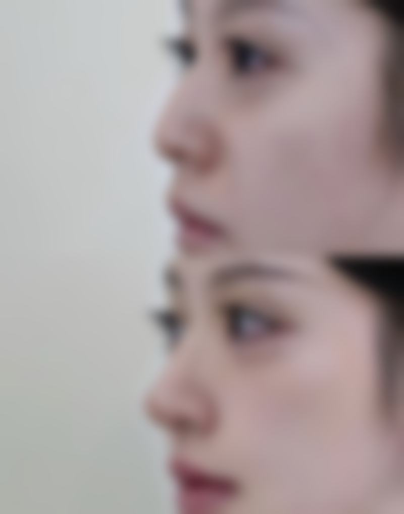 甲状腺手术后何时能用疤痕膏之医院相关信息