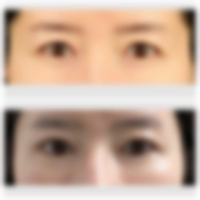 去眼袋副作用之——感染问题及应对办法