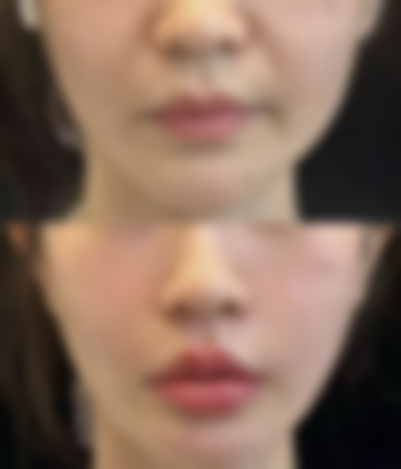 怎样借助中医方法,巧妙消除黑眼圈眼袋?