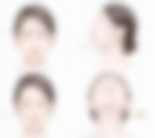 自体隆鼻软骨后遗症揭秘:如何降低风险,收获美丽?