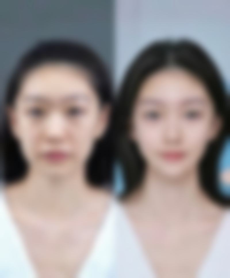 自体隆鼻软骨后遗症揭秘:美学成效风险几何,又该如何应对?