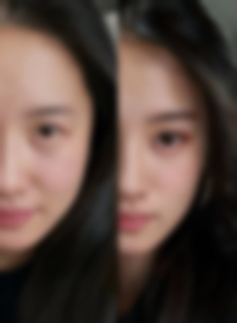 选对膨体材料，隆鼻效果加倍！射极峰、菲思挺等膨体优势全揭秘 