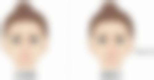 隆鼻后碰到鼻子会怎样?术后护理特别重要