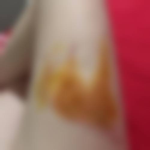 梁岷烧伤与整形实例