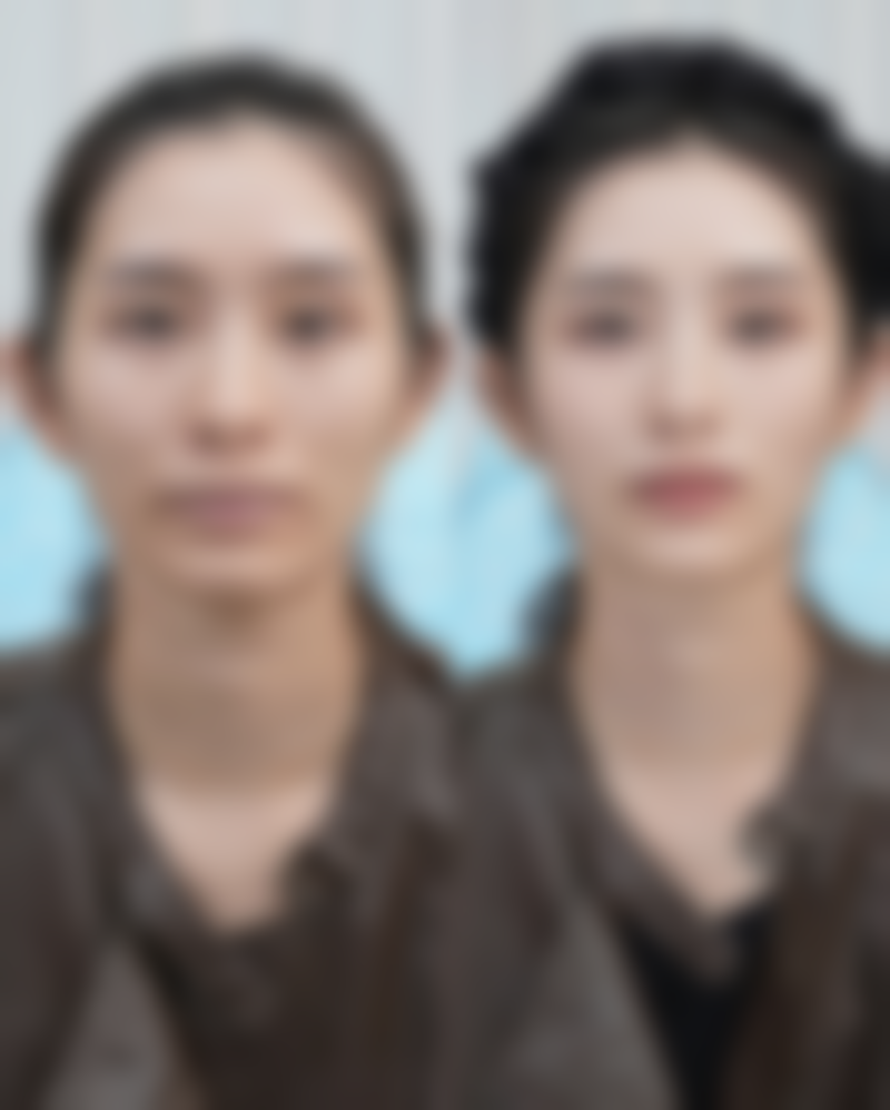 隆鼻后碰到鼻子会怎样?重度撞击需就医