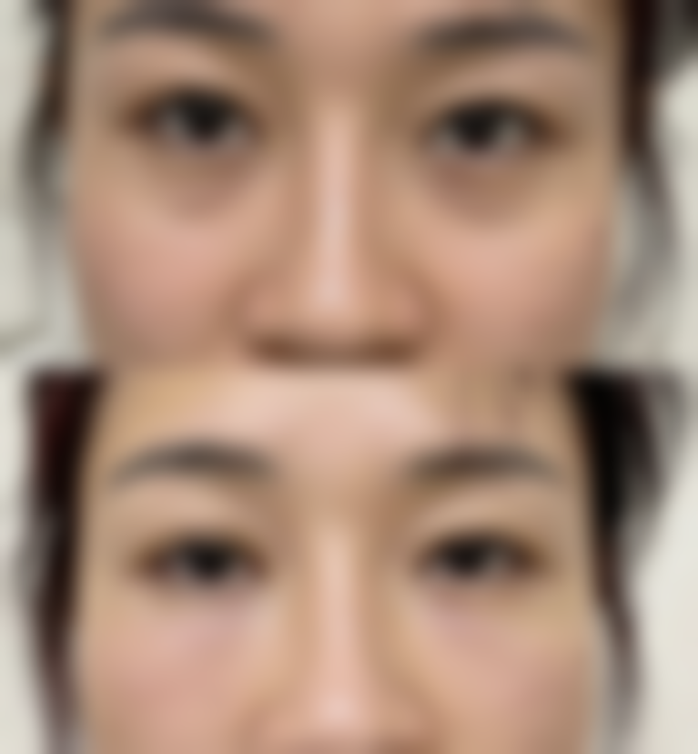 隆鼻后碰到鼻子会怎样?中度撞击有应对