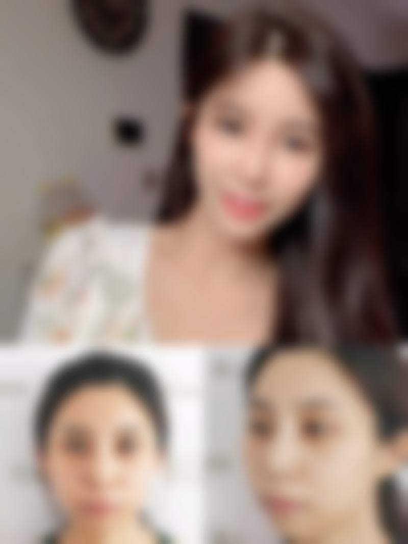 想去掉黑眼圈和眼袋？不同类型不同治疗方案