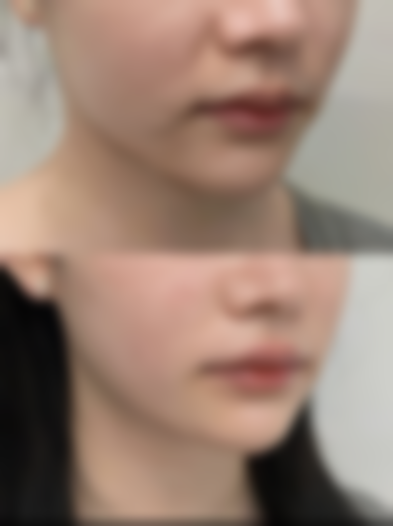 不同手术方式的修复时间对比