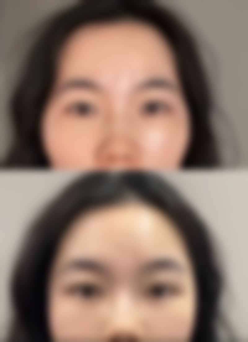 想去掉黑眼圈和眼袋？分型治疗+生活调理，还你明亮双眸焕发光彩 