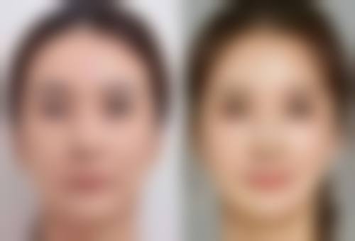 四、开封汴美整形医院实例