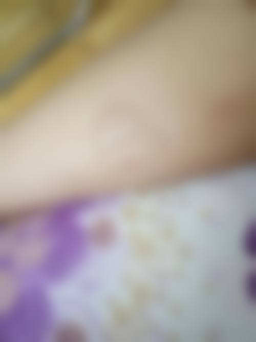 李孝建重度烧伤病人救治实例