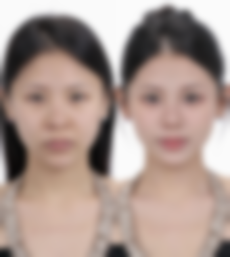 四、南宁爱思特整形美容医院实例