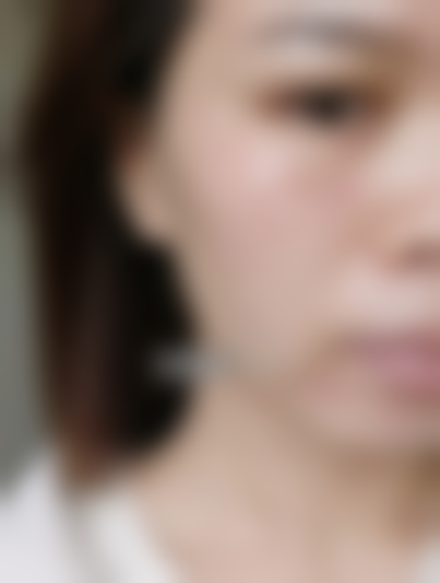 术后成效太惊喜，终于不用跟痘痘反复拉扯了