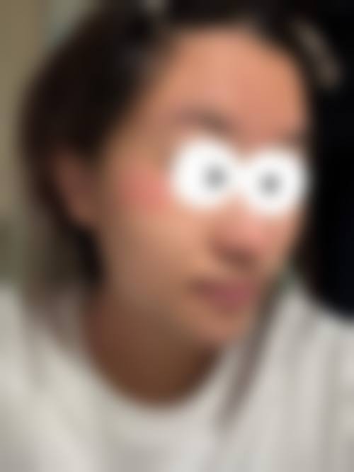 任善美治疗青春痘实例