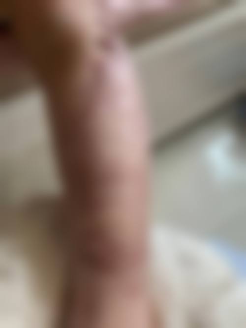 刘志勇烧伤治疗实例