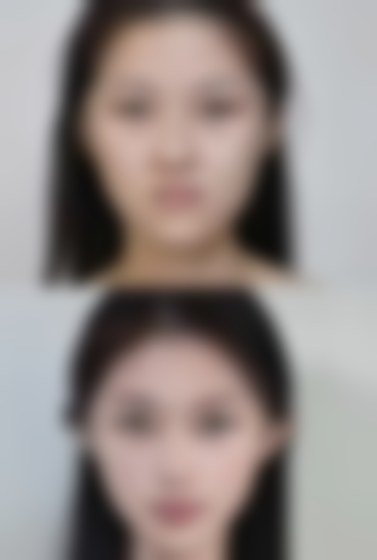 阿尔法、贝塞尔双眼皮等与全切双眼皮，如何选择适合自己的手术