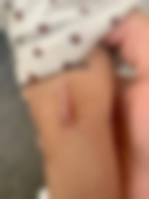 林伟华医生皮肤急慢性伤口、难愈创面的诊疗怎么样可靠吗?