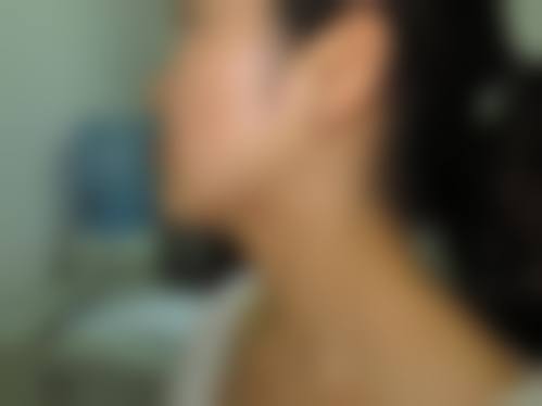 矫立仁医生增生性疤痕手术实例