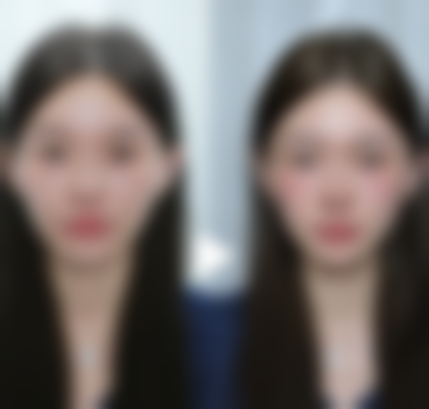 白色疤痕淡化：手术修复见真章