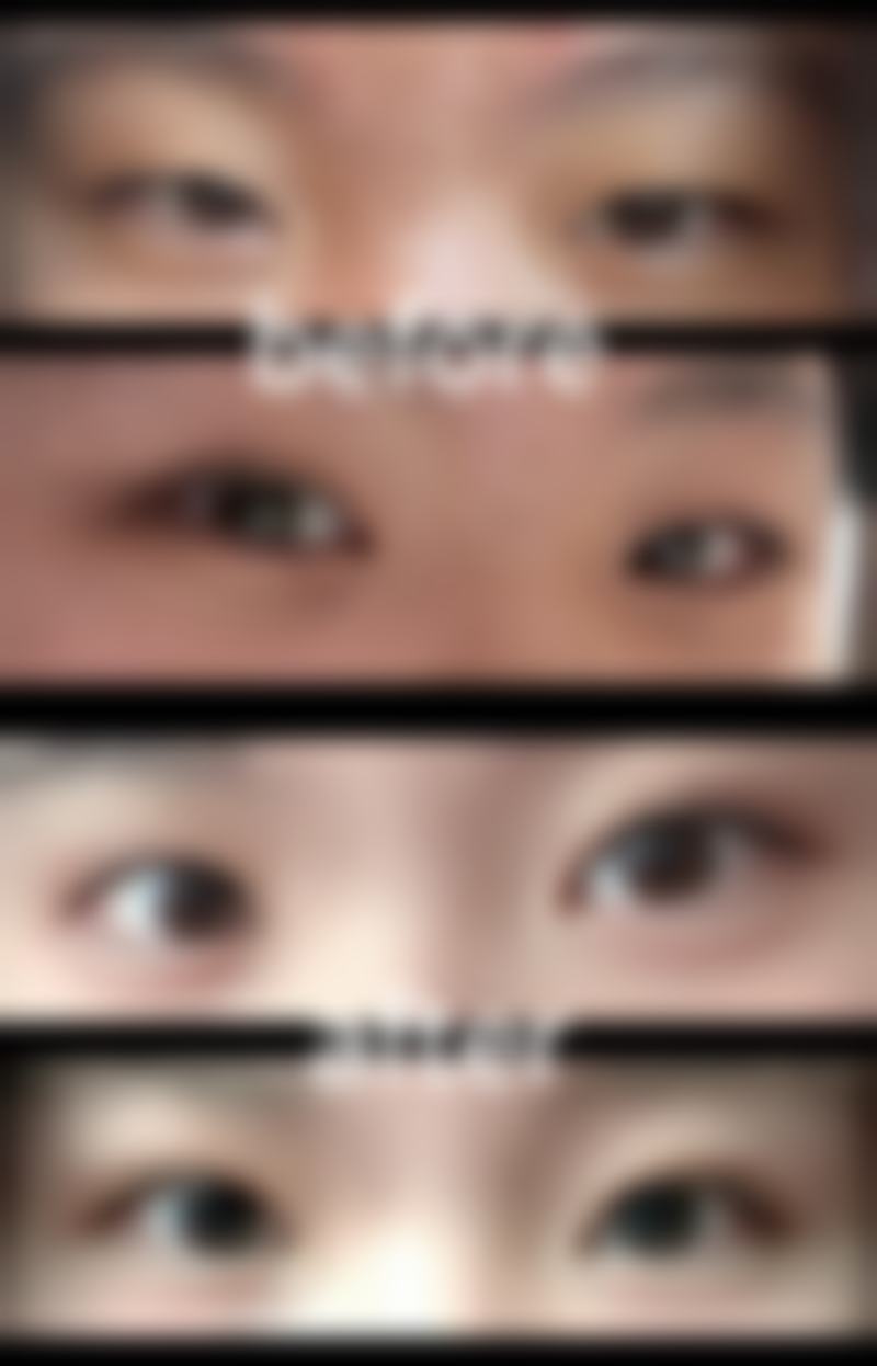 曹得全医生眼部整形实例