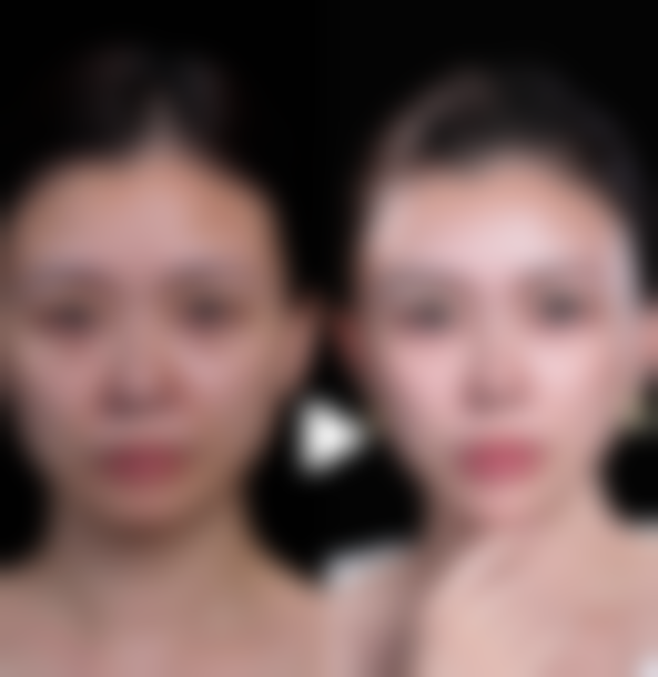 打完瘦脸针能吃东西吗？总结饮食技巧，守护瘦脸成果