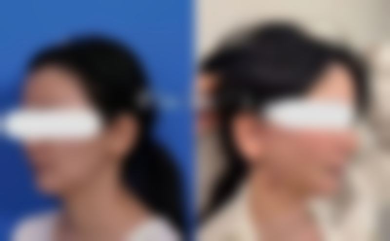 割双眼皮需留意啥？谨慎选择医院和医生