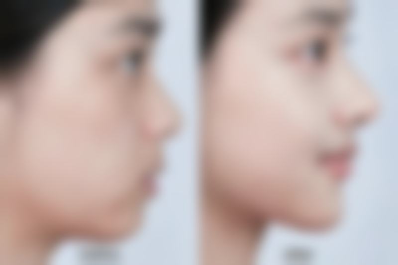 割双眼皮需留意啥？术后科学护理特别关键