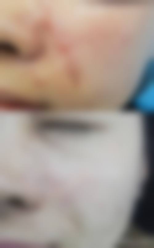 潘姝医生烧伤后增生性瘢痕的防治实例