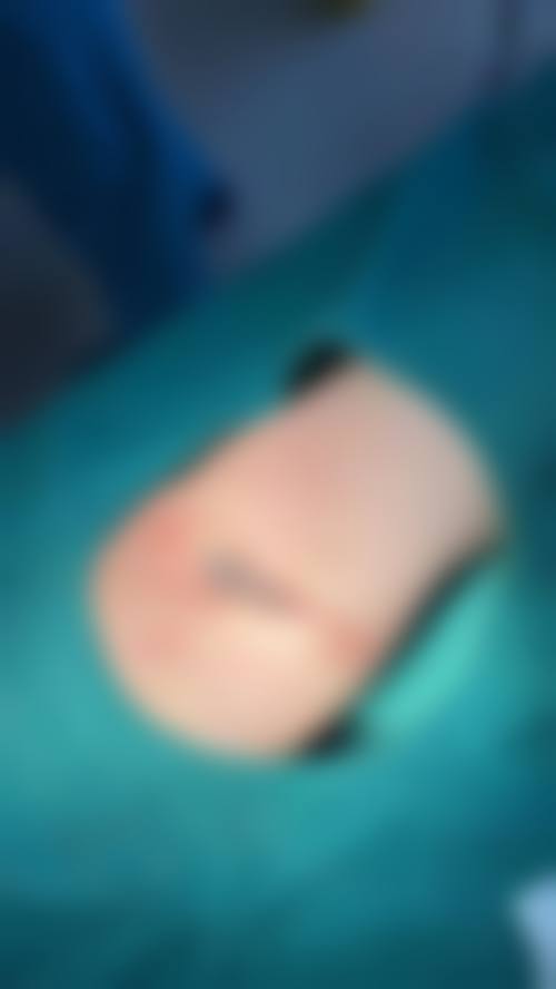 辛杰医生祛斑实例