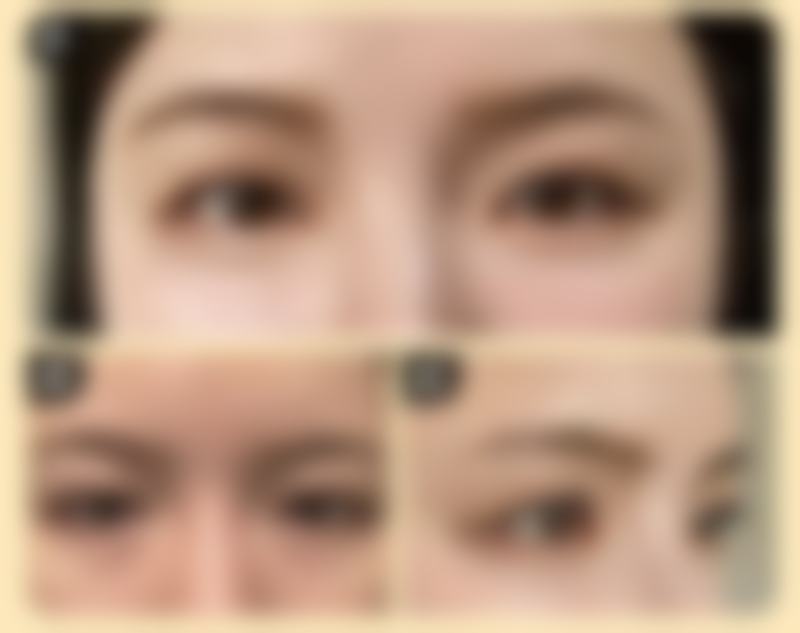 隆胸十年后会有后遗症吗?保持乐观心态特别关键