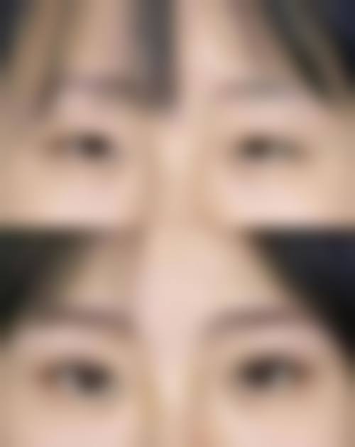 汪锦伦医生瘢痕及畸形整形实例