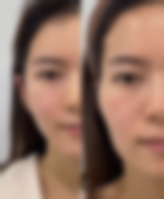 打瘦脸针多久能恢复自然？2 - 4 周见分晓，术后护理助力快速回归自然状态 