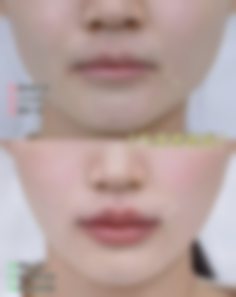 修复速度快，不耽误正常生活