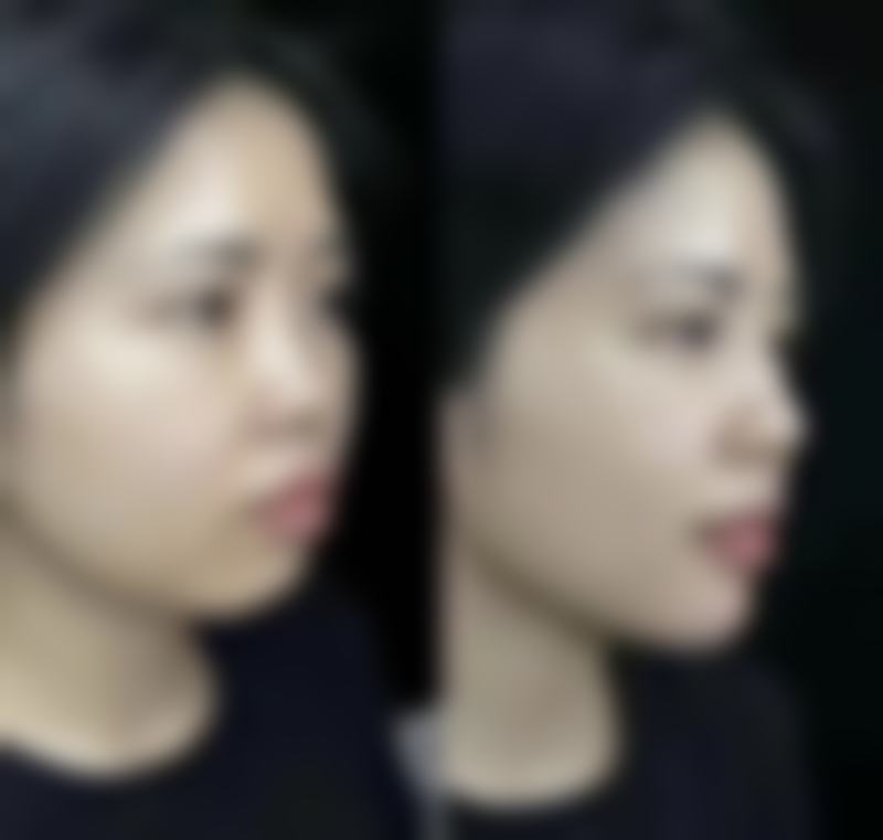 五、合肥美利来整形医院实例