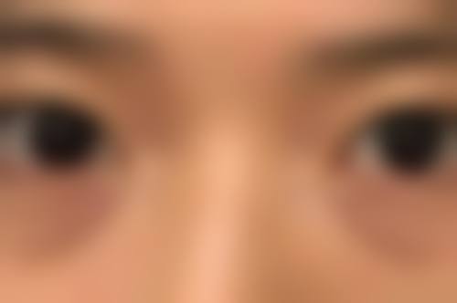 自体脂肪填充太阳穴的潜在问题