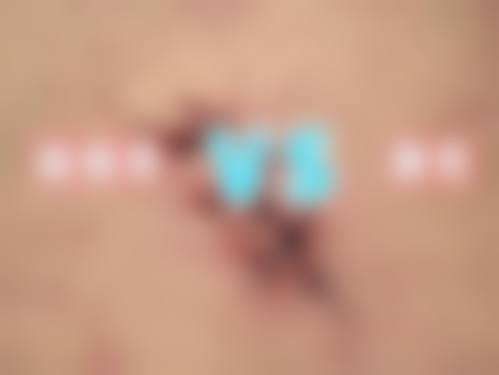 梁志刚医生烧烫伤治疗实例