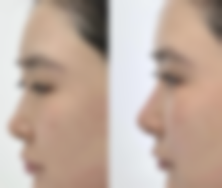 肋骨隆鼻能否管一辈子？揭秘影响持久效果的材料吸收、术后护理等关键因素 