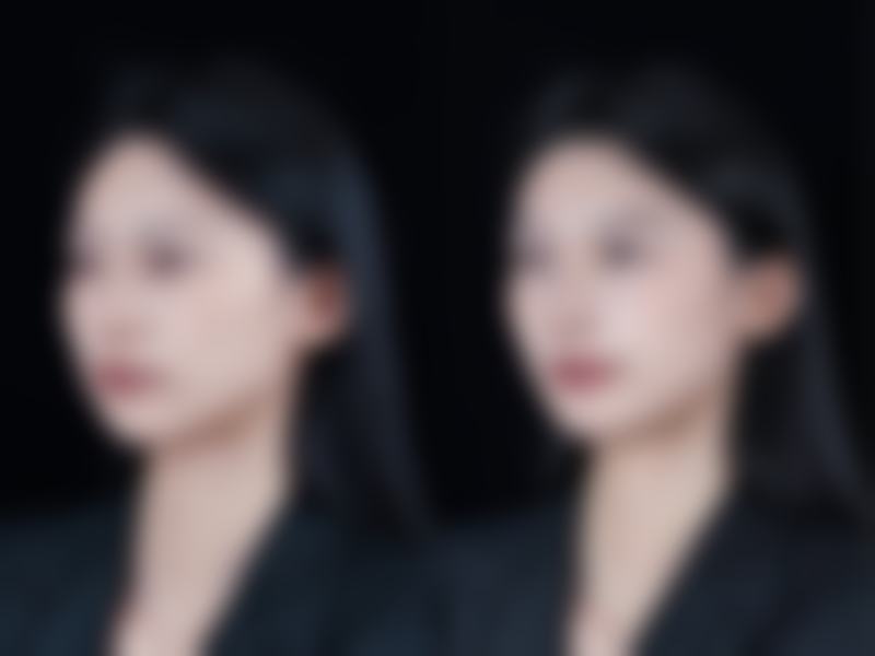 疤痕疙瘩治疗大揭秘：激光治疗焕新生