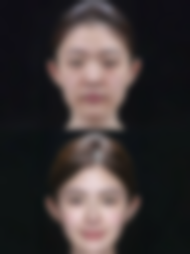 激光治疗点痣增生疤痕一次能好吗？程度、体质、护理多因素影响治疗效果 