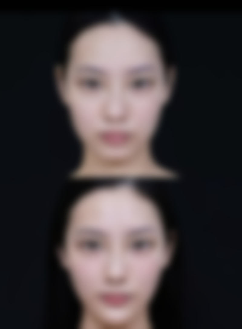 激光治疗点痣增生疤痕一次能好吗？术后护理是关键