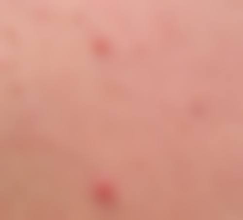 五、丽优美皮肤科蚕室店实例