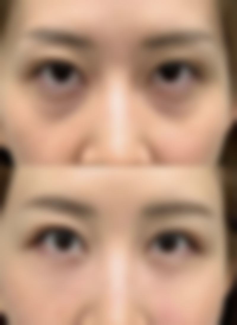 特殊人群突然双眼皮肿了咋办？注意事项要牢记