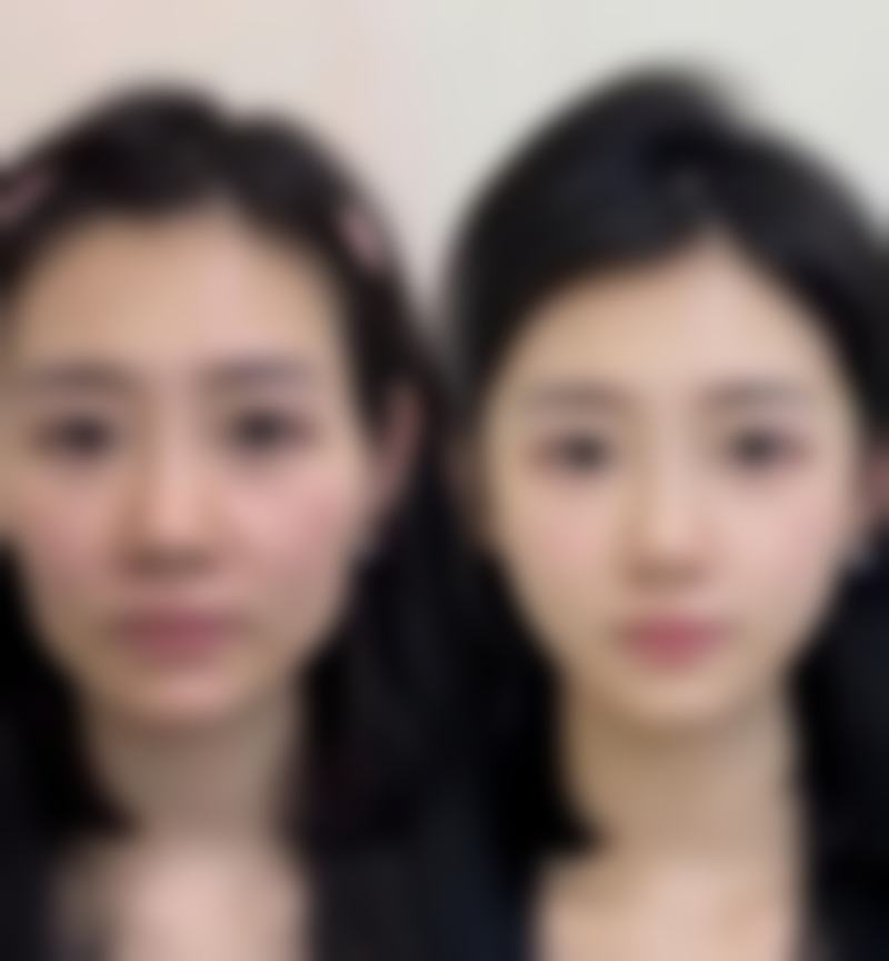 突然双眼皮肿了啥时候该就医？就医提示要重视