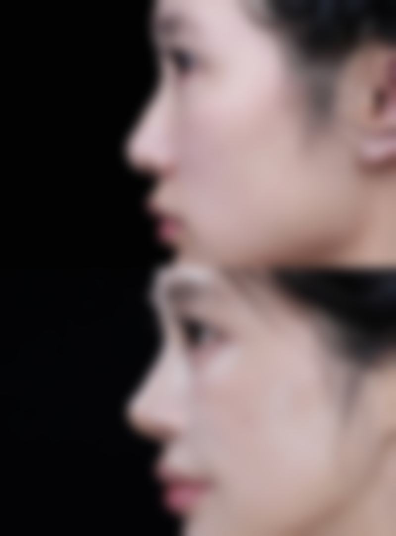 想知道非手术物理治疗去眼袋咋样？安心便捷成效好