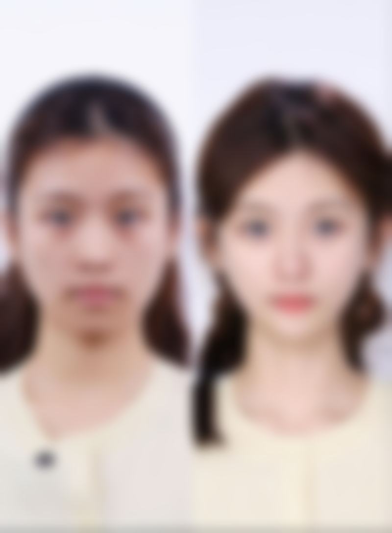 肋骨隆鼻硬度会一直持续吗？揭秘恢复周期、影响因素与异常处理方案 